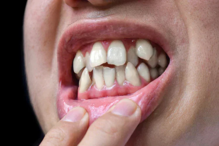 Una persona que muestra dientes torcidos.