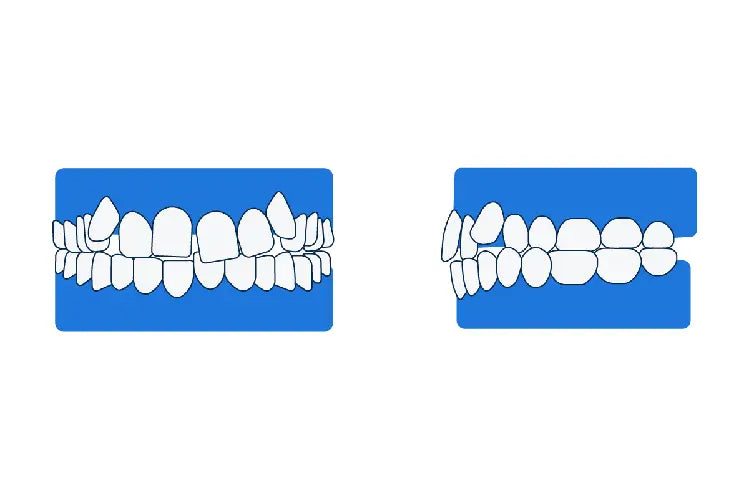 Una ilustración de dientes torcidos