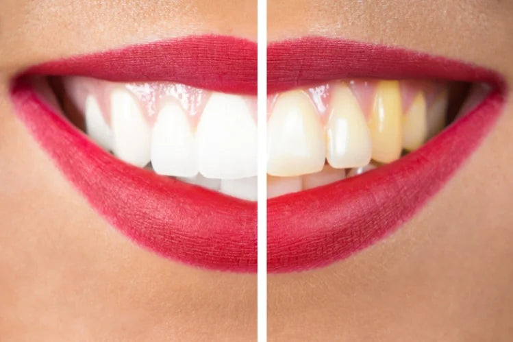Blanqueamiento dental antes y después