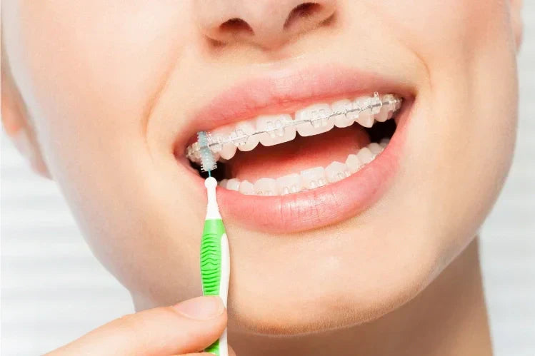 Una niña usa un cepillo interdental de cerdas suaves para limpiar los aparatos de cerámica.