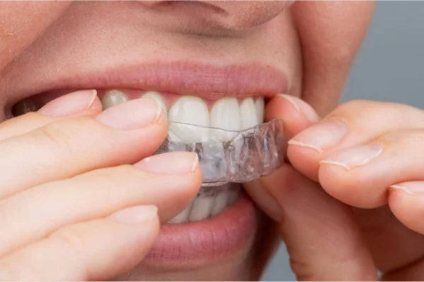 clear aligners for teeth straightening