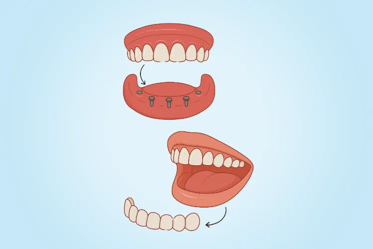 Ilustración de carillas a presión y dentaduras postizas a presión