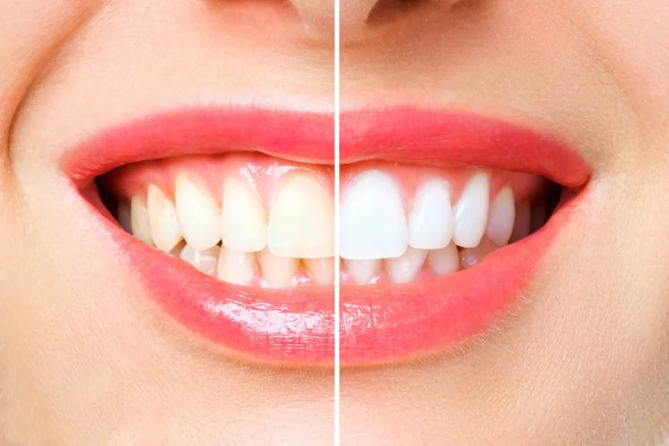 Blanqueamiento dental antes y después.