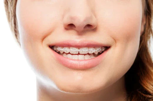 Una mujer sonriendo mientras usa brackets cerámicos