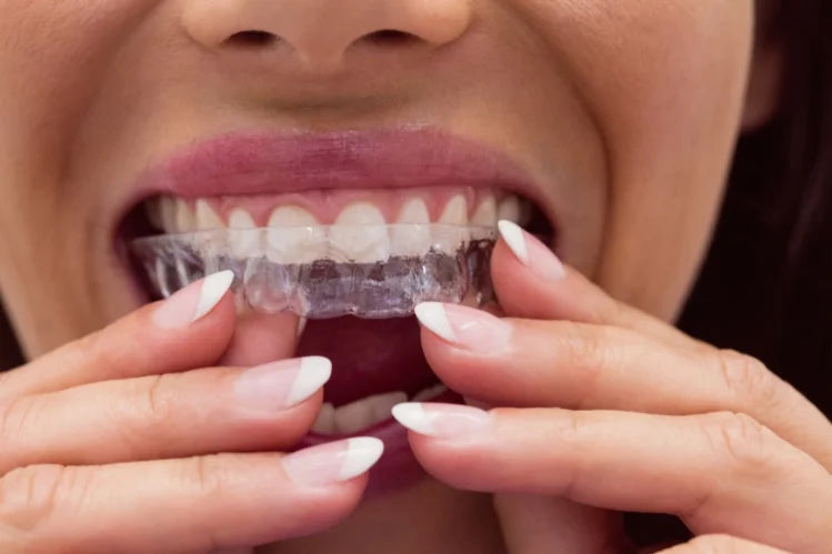 clear aligners