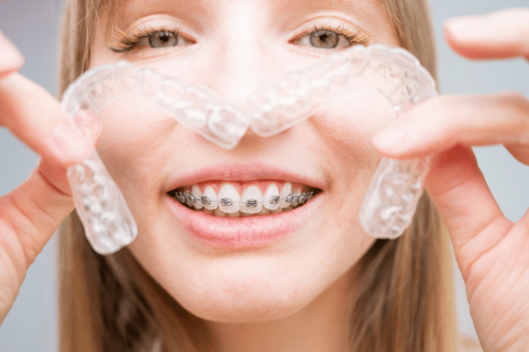 clear aligner
