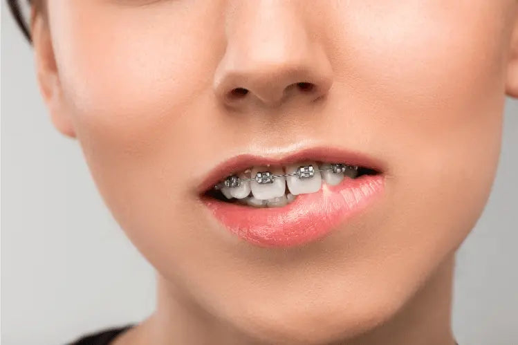 Overbite Wearing Braces