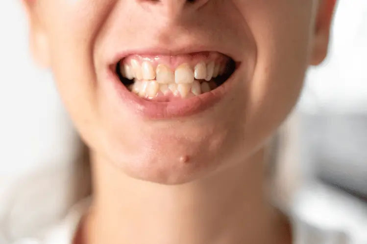 crowded teeth