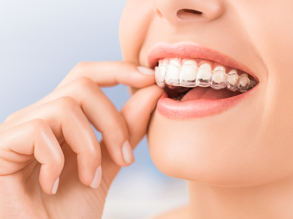 Teeth Retainers