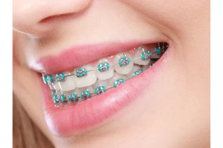 Imagen de cerca de una mujer con aparatos dentales azules.