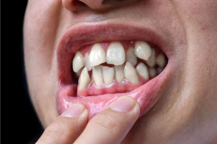 Primer plano de dientes torcidos