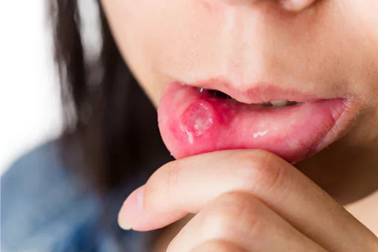 Una persona que presenta aftas en la cara interna del labio.