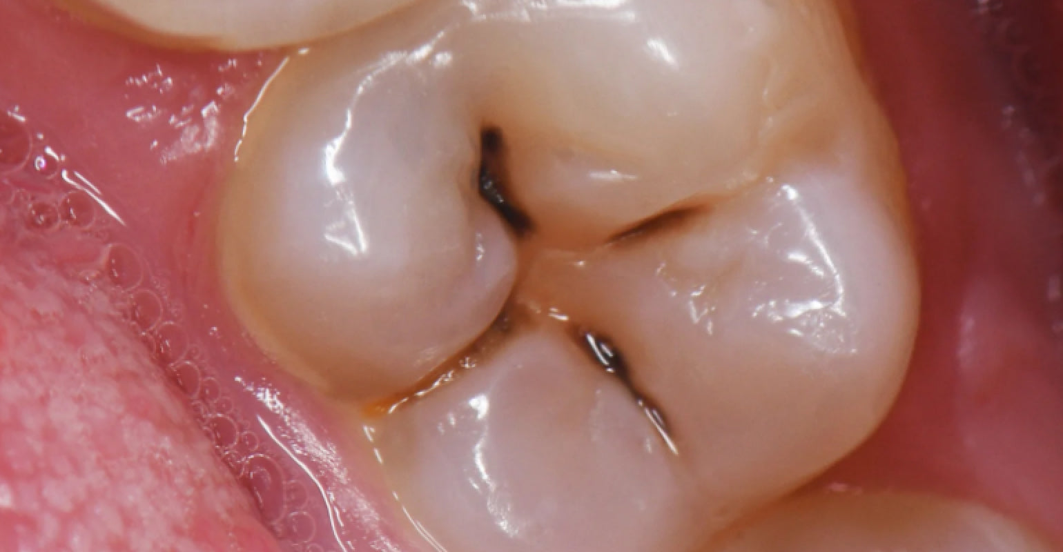 Imagen de un diente con caries.