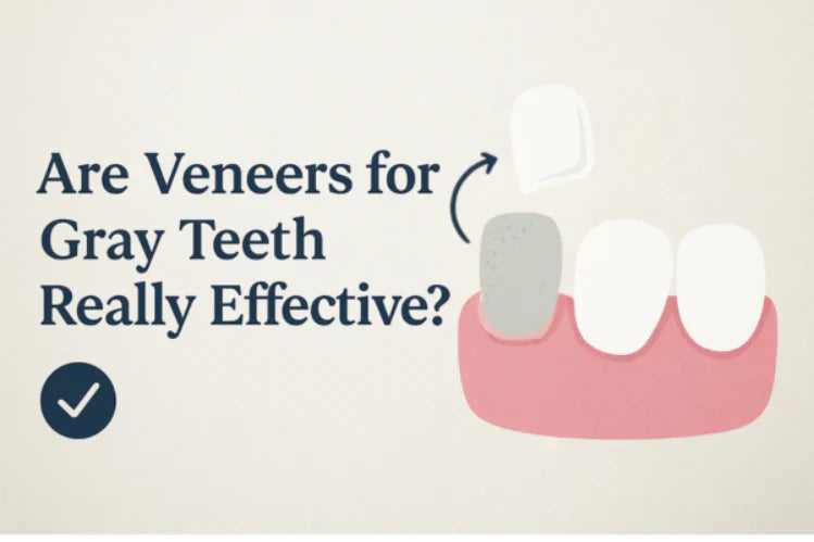 Ilustración que muestra un diente gris cubierto con una carilla dental.