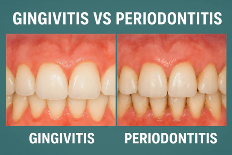 Comparación lado a lado de la gingivitis frente a la periodontitis