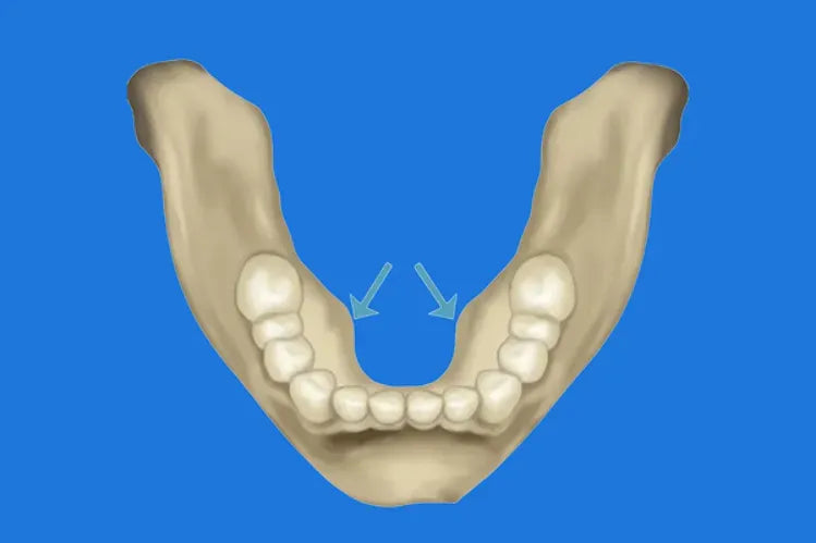 Torus mandibular: Entendiendo las protuberancias óseas en la boca