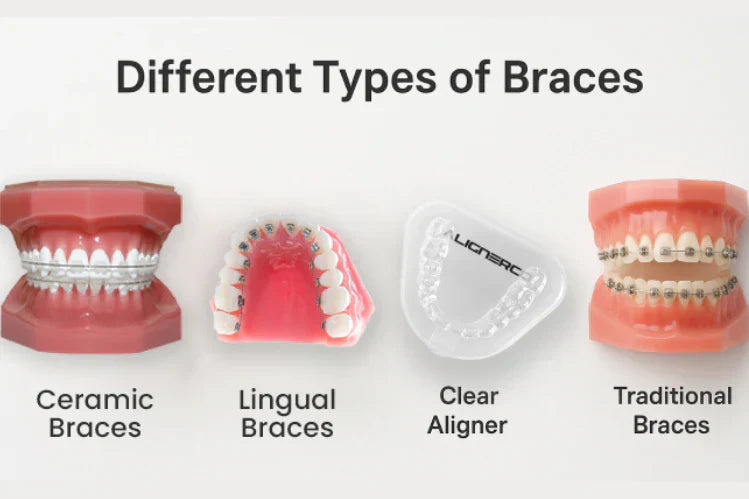 Tipos de brackets transparentes
