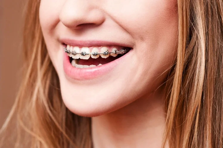 Una chica sonriendo con brackets metálicos