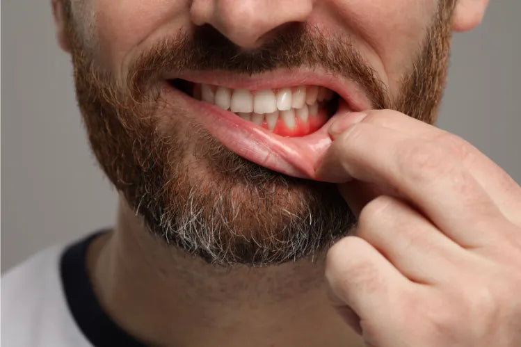 Un hombre mostrando sus encías inflamadas.