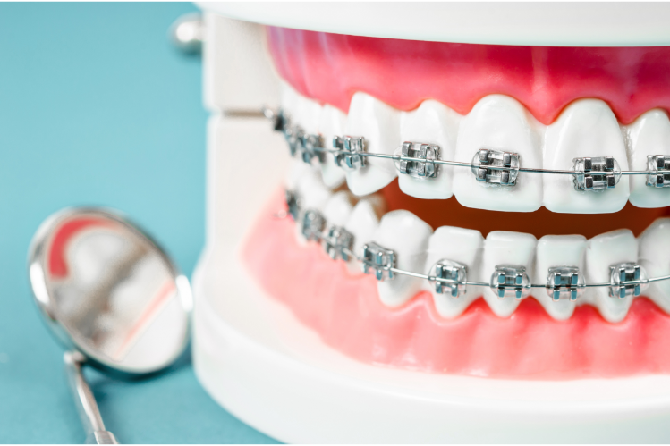 brackets se rompan o lastimen