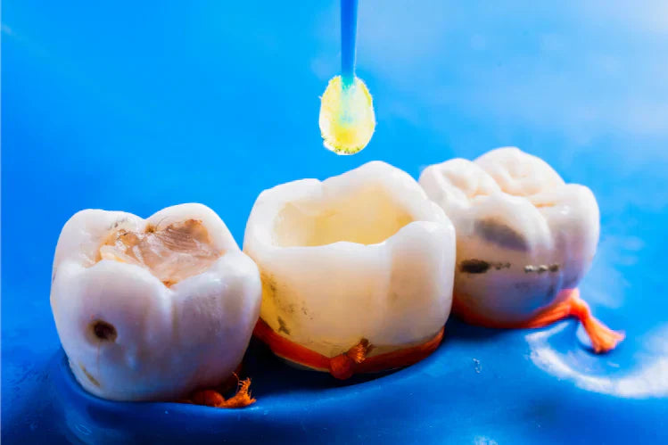 Dental filling on a tooth
