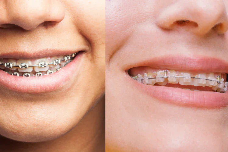 Una imagen de una comparación lado a lado de brackets de cerámica y blancos