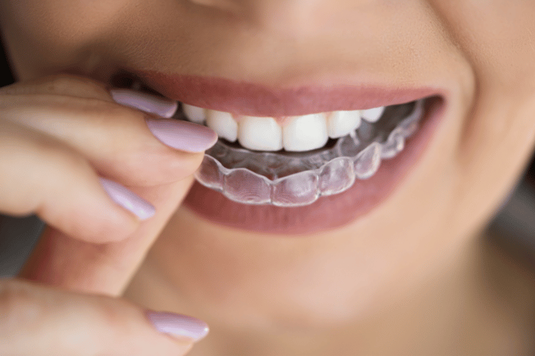 Close-up Of A Girl's Hand Putting Transparent Aligner In Teeth
