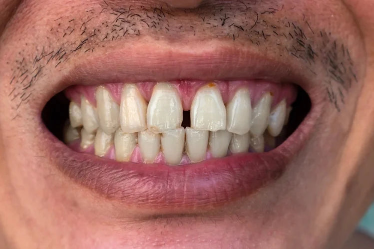 dental gap